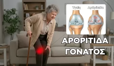 ΟΣΤΕΟΑΡΘΡΙΤΙΔΑ ΓΟΝΑΤΟΣ