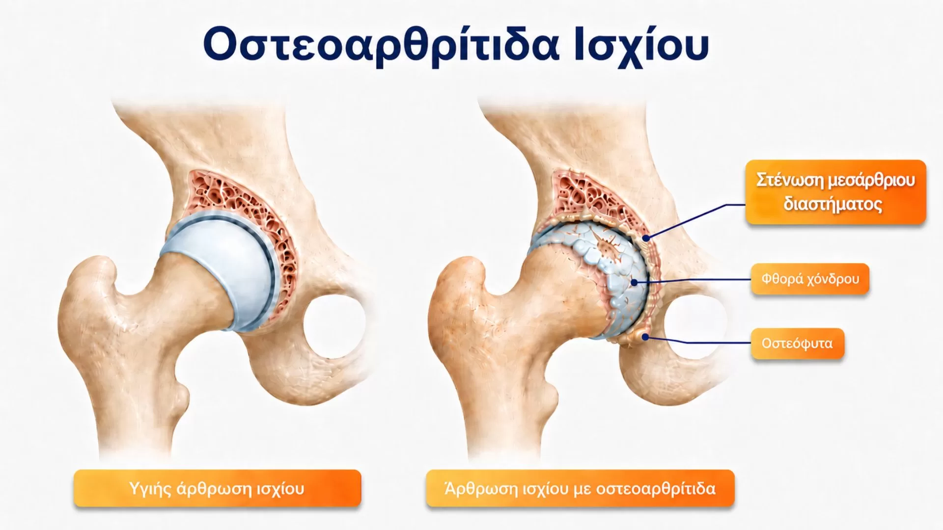 Οστεοαρθρίτιδα Ισχίου υγιης αρθρωση αρθρωση με αρθρίτιδα