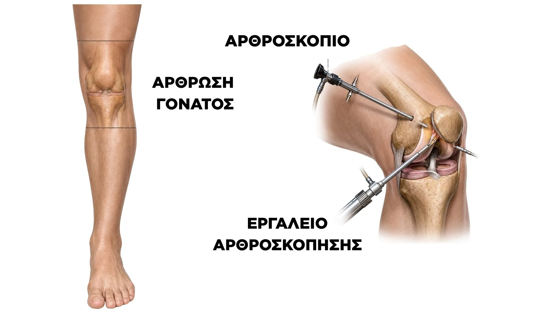 Αρθροσκόπηση Γόνατος: Αποκατάσταση - Τι Πρέπει να Κάνεις για να Επιστρέψεις με Ασφάλεια