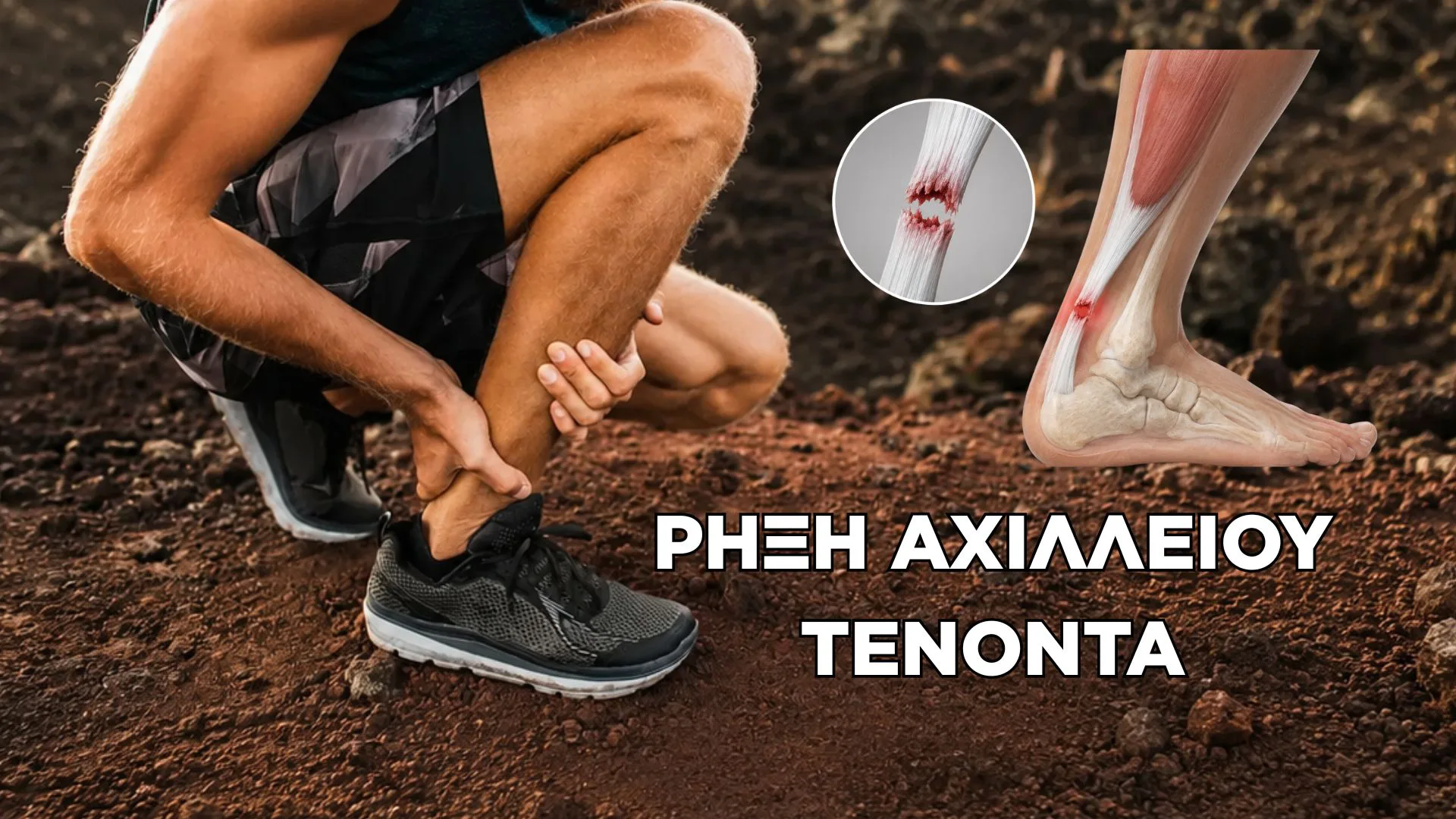 Ρήξη Αχιλλείου: Συμπτώματα, Θεραπεία και Αποκατάσταση